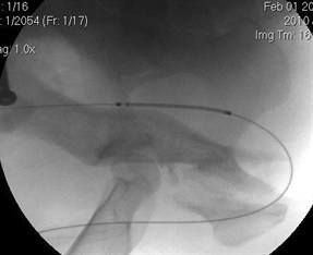 stent 2crop stent 2crop